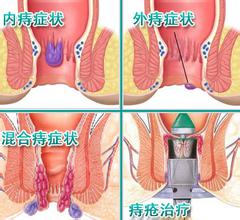 什么是痔疮