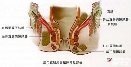 肛周脓肿如何治疗