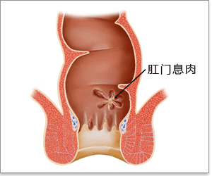 肛门息肉有害吗