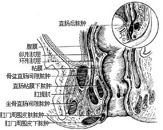 肛周脓肿怎么治